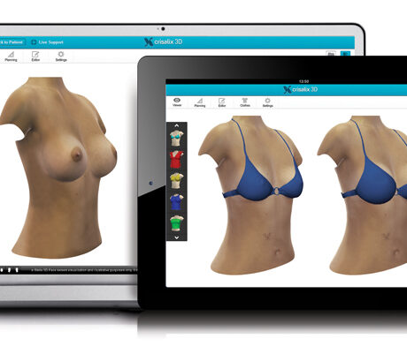 3D Simulation vor der Brustvergrößerung