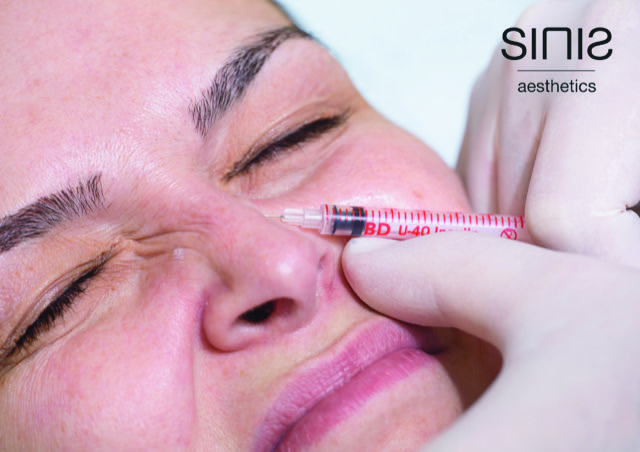 Offene oder geschlossene Nasenoperation? Nasenkorrektur bei Sinis Aesthetics